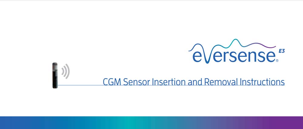 Eversense E3 Sensor Insertion and Removal Instructions